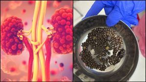 హైదరాబాద్ డాక్టర్లు ఆపరేషన్ లేకుండా ఆ టెక్నాలజీతో అతని కిడ్నీలో ఏకంగా 418 కిడ్నీలను తొలగించిన ఘనత.!