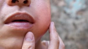 Mumps Cases Increase : పెరుగుతున్న గవదబిళ్లల కేసులు.. ఎమ్‌ఎమ్‌ఆర్ వ్యాక్సిన్ తీసుకున్నారా ?