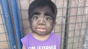 వళ్లంతా వత్తైన జుట్టుతో పసిబాలుడు.. తల్లి దానిని తన్నందుకేనా..?