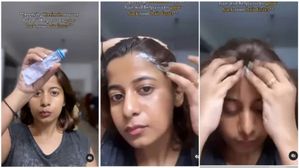 జుట్టు రాలడాన్ని నివారించడానికి మొటిమల మందు వాడిన యువతి..!చివరికి ఏమైంది. ఫలితం చూసి షాక్..!