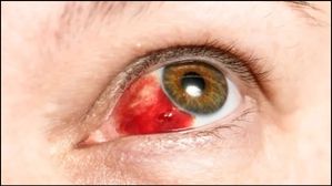 కళ్ళ నుండి రక్తస్రావం: ఎబోలా లాంటి వైరస్‌తో ఒకరు మరణించారు, WHO దీనిని ప్రమాదకరమైన వ్యాధిగా పరిగనిస్తోంది