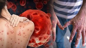Mpox Outbreak:మంకీపాక్స్‌కు సంబంధించి ఢిల్లీ ఎయిమ్స్ మార్గదర్శకాలు లక్షణాలు కనిపించిన వెంటనే ఈ పనులు చేయండి