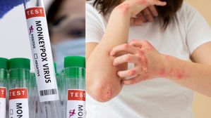 కేరళ రెండవ మంకీపాక్స్ కేసు కలంకం రేపుతోంది: హై అలర్ట్‌ ప్రకటించిన ఆరోగ్య శాఖ, లక్షణాలు, నివారణ ఇలా