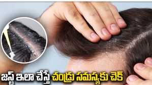 dandruff in winter: జస్ట్ ఇలా చేస్తే చండ్రు సమస్యకు చెక్!