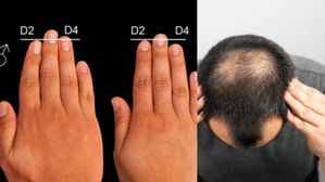 మీ చేతి వేళ్ళు ఇలా ఉంటే మీకు కచ్చితంగా బట్టతల వస్తుంది!