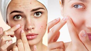 Pimples on face: మొటిమలతో బాధపడుతున్నారా? జస్ట్ ఇది వాడితే మ్యాజిక్ జరిగి మొత్తం పోతాయ్!