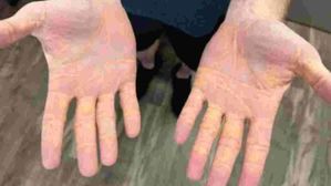 మాంసం తింటే కొత్త రోగం.. చేతులు ఇలా మారిపోతున్నాయట,ఎలా గుర్తించాలంటే?