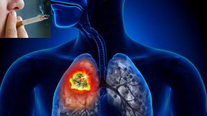 స్మోకింగ్ చేయనివారికే లంగ్ క్యాన్సర్!..వెలుగులోకి సంచలన విషయాలు