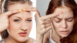 Pimples on Forehead: నుదిటిపై తరచుగా మొటిమలు వస్తున్నాయా? శరీరంలోని ఆ భాగం ప్రమాదంలో!