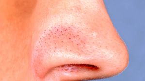 ముక్కుపై నల్ల మచ్చలు ఉన్నాయా? ఇవి అప్లై చేస్తే రెండు రోజుల్లో మచ్చలు మటుమాయం!