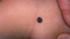 అక్కడ పుట్టుమచ్చ ఉంటే, చచ్చిపోయేలోపు కచ్చితంగా కోటీశ్వరులు అవుతారు.. మీకు కూడా ఉందా?