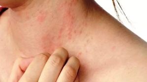 వామ్మో.. ఎండలో బయటికి వెళ్తే ఇంత ప్రమాదకర చర్మ వ్యాధులు వస్తాయా? బయటపడాలంటే ఈ టిప్స్ పాటించండి!