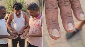 వామ్మో ఇండియాలో అతి భయంకరమైన వింత వ్యాధి.. లక్షణాలు ఎలా ఉంటాయంటే?