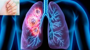 ఊపిరితిత్తుల క్యాన్సర్ ముప్పును మీ వేళ్ళతోనే పసిగట్టండి! కేవలం 5 సెకన్లలో..