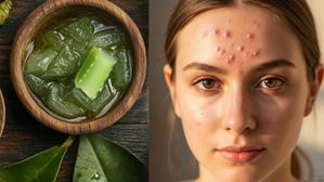 నుదుటిపై మొటిమలతో విసిగిపోయారా? ఇది పూస్తే జన్మలో మళ్లీ రమ్మన్నా రావు!