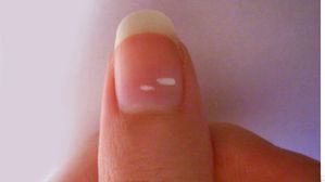 గోళ్లపై తెల్లటి గీతలు ఉన్నాయా? ఆ ప్రమాదకరమ వ్యాధికి సంకేతమే!