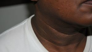 మెడ,సంకల్ల,గజ్జల్లో చర్మం నల్లబడటానికి కారణం ఇదే..ఏం చేస్తే తగ్గుతుందంటే..