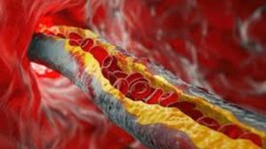 చెడు కొలెస్ట్రాల్‌ తో జాగ్రత్త..ఉదయాన్నే ఈ చిన్న మార్పులు చేసుకుంటే గుండెకు ఢోకా ఉండదు