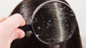 మొండి చుండ్రు వదలట్లేదా? ఇలా చేసి చూడండి..ఫలితం పక్కా!