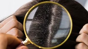 కేవలం 2 పదార్థాలు..చుండ్రు మాయం! ఒత్తైన జుట్టు మీ సొంతం