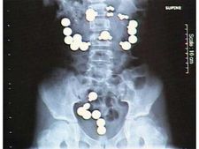 (ছবি) ৯টি অদ্ভুদ জিনিস পাওয়া গিয়েছে মানুষের পেটে!