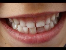 আপনার সামনের দুটো দাঁতের মাঝে ফাঁক আছে নাকি? তাহলে আপনি এমন...