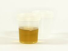 প্রস্রাবের সময় ফেনা হলে কিন্তু চিন্তার বিষয়!