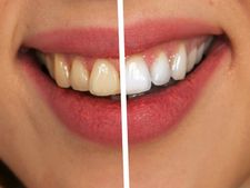 হালুদ দাঁতকে সুন্দর করে তুলতে কাজে লাগান এই ঘরোয়া পদ্ধতিগুলিকে!