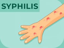 সিফিলিস কী? কারণ, লক্ষণ, চিকিৎসা ও প্রতিরোধ