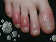 পায়ের লালচেভাব বা ক্ষত কী কোভিড-১৯ এর নতুন উপসর্গ? জানুন বিশেষজ্ঞদের মত