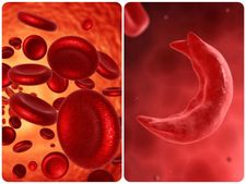 সিকল সেল ডিজিজ কী? জেনে নিন এর প্রকার, লক্ষণ, রোগ নির্ণয় ও চিকিৎসা সম্পর্কে