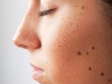 মুখে একাধিক তিল নিয়ে সমস্যায় পড়েছেন? দেখুন অতিরিক্ত তিল দূর করার ঘরোয়া উপায়