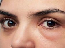 চোখের ফোলাভাব কমাতে মেনে চলুন এই ৬টি টিপস