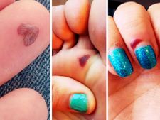 সহজ ঘরোয়া উপায়েই সারবে ব্লাড ব্লিস্টার, দেখে নিন কী করবেন