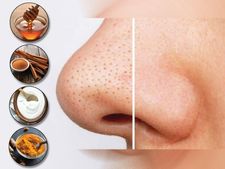 নাকের দু'পাশে জেদি ব্ল্যাকহেডস? ঘরে বসেই দূর করুন এই ৪ সহজ উপায়ে!