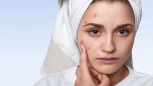 Anti-Acne Diet: ব্রণ থেকে চিরতরে মুক্তি চান? রোজকার ডায়েটে রাখুন এই ৬ খাবার!