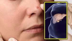 Fatty Liver Symptoms: মুখ ফুলে যাচ্ছে? ব্রণর সমস্যা? ফ্যাটি লিভারে আক্রান্ত নন তো?