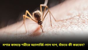 মশার কামড়ে চুলকানি-জ্বালাভাব, চট করে মুক্তি পান এই ঘরোয়া উপায়ে