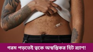 গরম পড়তেই ত্বকে অস্বস্তিকর হিট র‍্যাশ! জানেন কী কী এড়িয়ে চলবেন? প্রতিকার