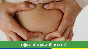 স্ট্রেচ মার্ক নিয়ে দুশ্চিন্তা? ঘরোয়া এই উপায় মানলেই রোখা যাবে!