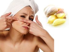 ખીલનાં ડાઘા હોય કે બ્લૅકહૅડ્સ, બધું દૂર કરે લસણનું મૉસ્ક