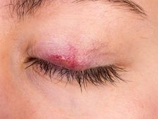 વિશ્વ કુષ્ઠ નિવારણ દિવસ પર જાણો તેના ૭ લક્ષણ