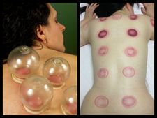 કપિંગ થેરેપીના આ નિશાન છુટકારો અપાવશે આ ૮ બીમારીઓથી