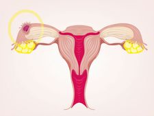 શું C-Section કરાવવાની પણ કોઈ લિમિટ હોઈ શકે ?