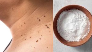 बिना किसी दर्द के झड़ जाएगा सालों पुराना मस्सा, बस चूने का ऐसे करें इस्तेमाल