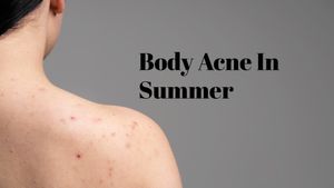 Body Acne in Summer: Why It Happens and How to Deal With It