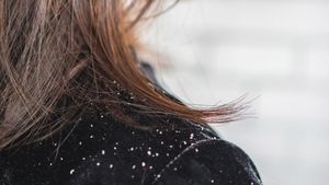 Monsoon Haircare: How To Tell If It's Monsoon Dandruff Or Something More Serious