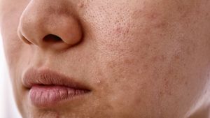The Skin Barrier Crisis: Is Your Skincare Routine Damaging Your Skin?