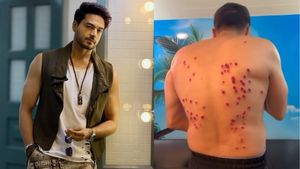 Gaurav Khanna Reveals Painful Laser Burn Marks From Khatron Ke Khiladi 15