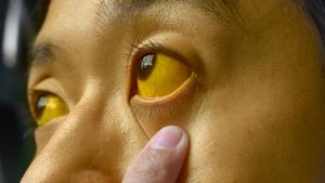 Jaundice in Adults: Doctor Explains When a Bile Duct May Be Blocked